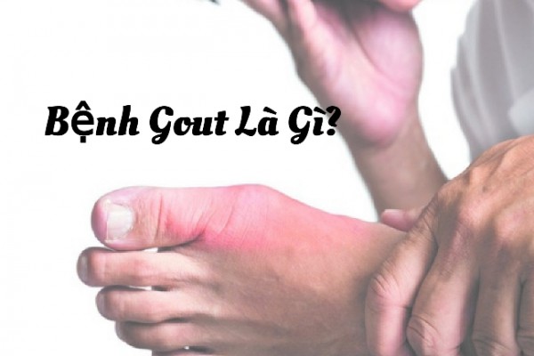 Bệnh Gout Là Gì? Phương Pháp Hỗ Trợ Điều Trị.